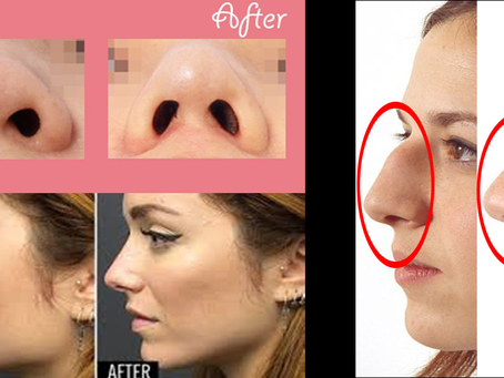 La rinoplastia, la cirugía plástica más estética. Rinoplastia Naturales