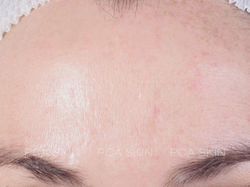 Acne After