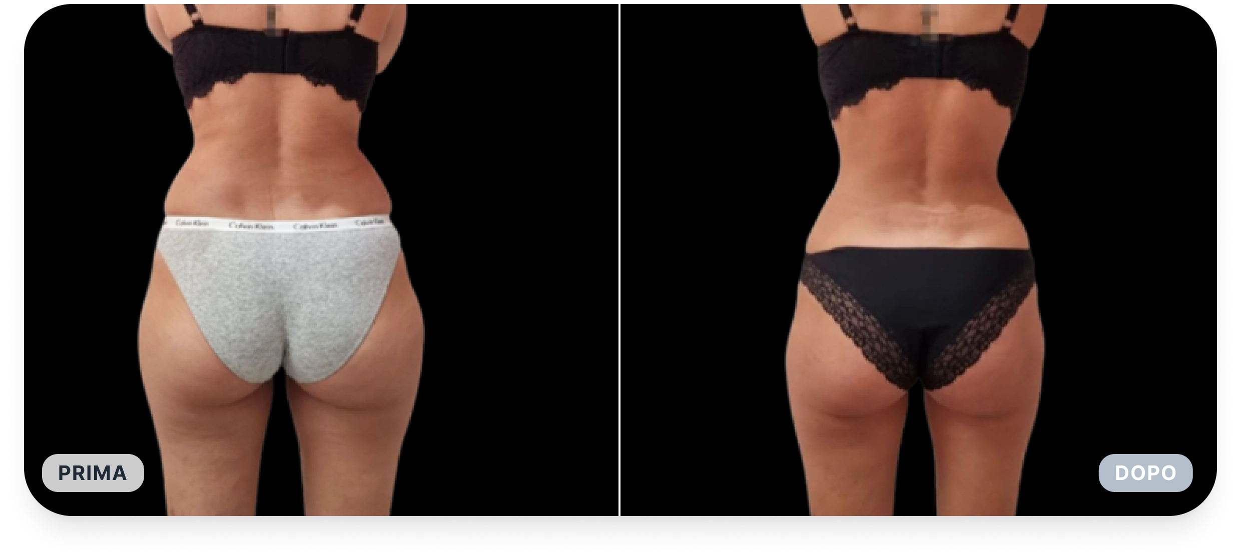 Rimodellamento delle cosce.png