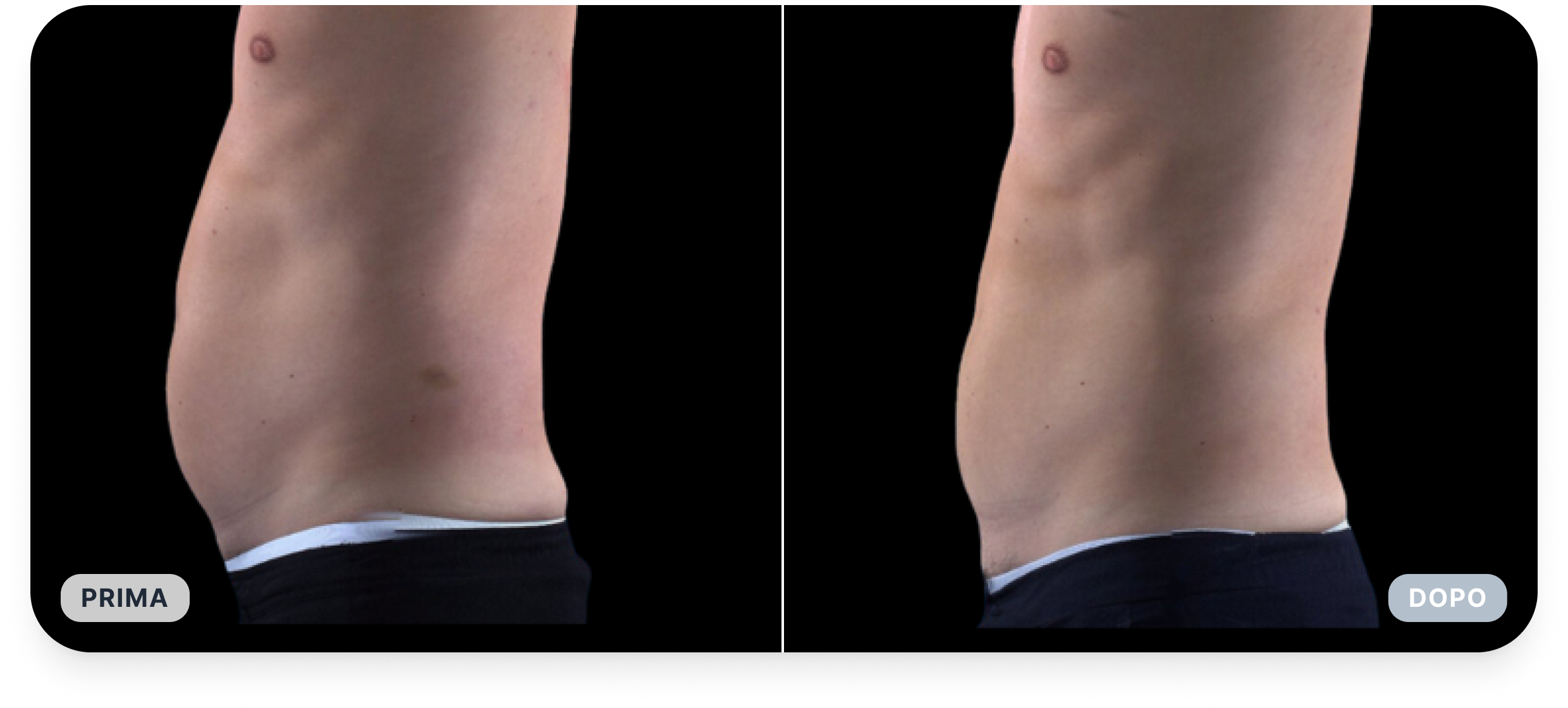 Rimodellamento addominale.png
