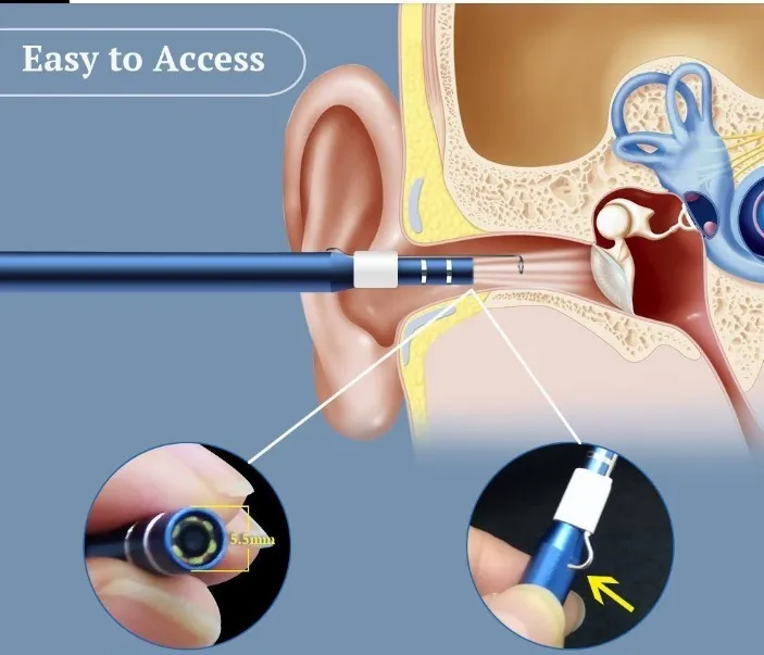 Miniatura: Otoscopio Digital, Videotoscopio Con Removedor De Cera