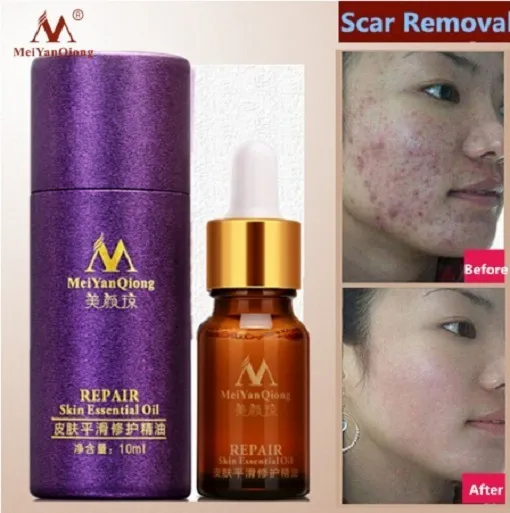 Miniatura: Tratamiento Par Cicatrices, Acné, Cicatices