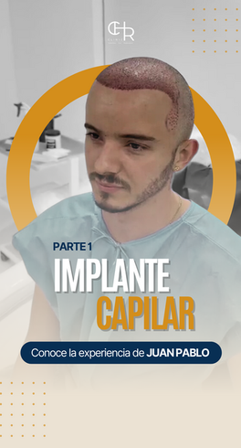 Caso exitoso de implante capilar