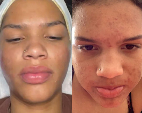 Acne treatment in Bakersfield California from a bakersfield esthetician