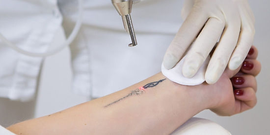 tattoo removal near me