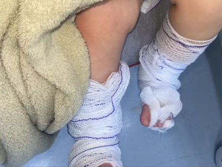 Prefeitura de Campo Bom demite servidora após bebê sofrer queimaduras de 2º grau depois de banho em escola