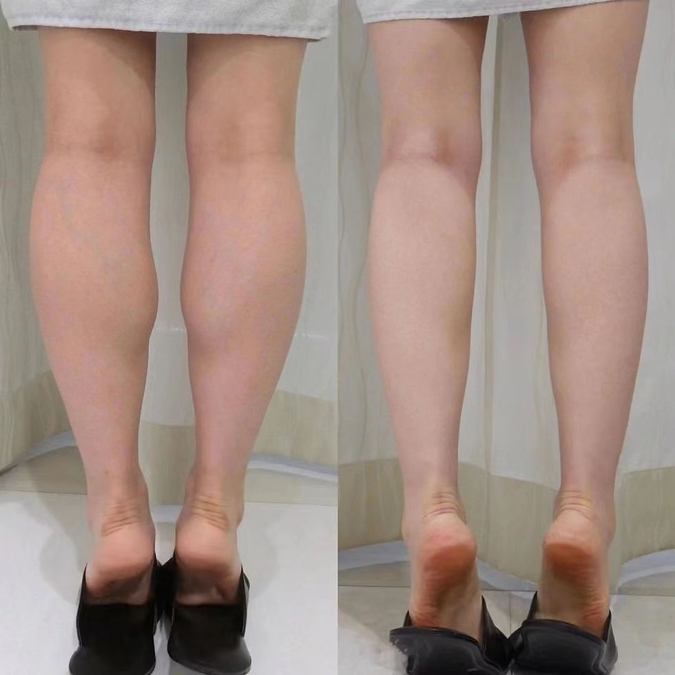 Botox | Leg slimming (More affordable packages available!)