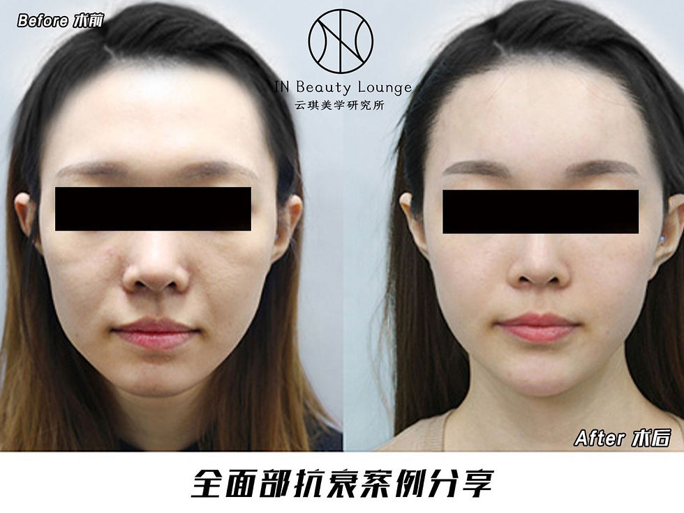 Contouring | Ligament Lifting | Jawline Reshaping