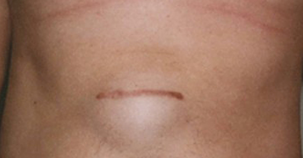 Arrbrokk | Bukveggsbrokk.no