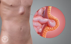 epigastric-hernia.jpg