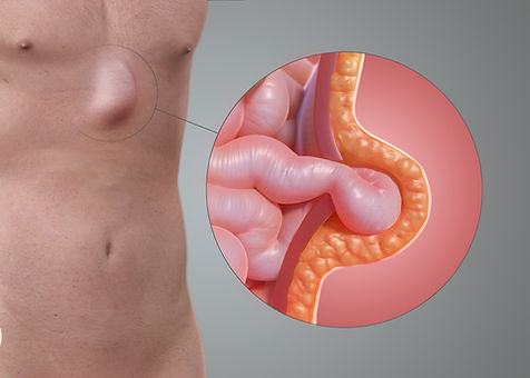 Epigastrisk brokk
