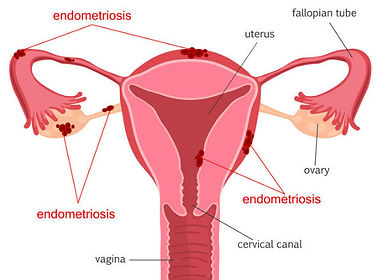 Symptoms and Signs of Endometriosis - Clinic 66 Chatswood