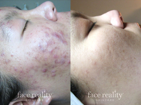 Acne Skin, Acne treatment, facials, 