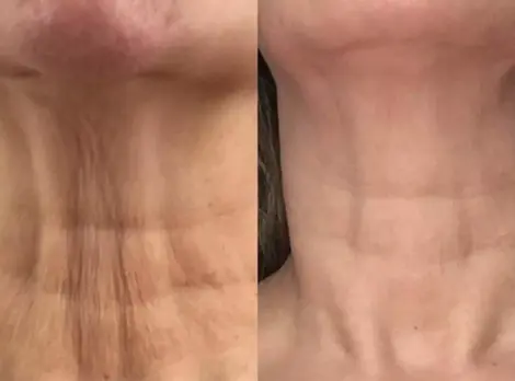fibroblast plasma skin tightening