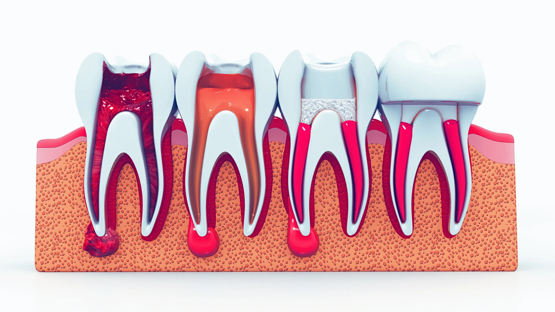 Fill Access Pot Rct Root Canal Treatment (RCT) | Pain-Free Treatment at YOUR DENTIST