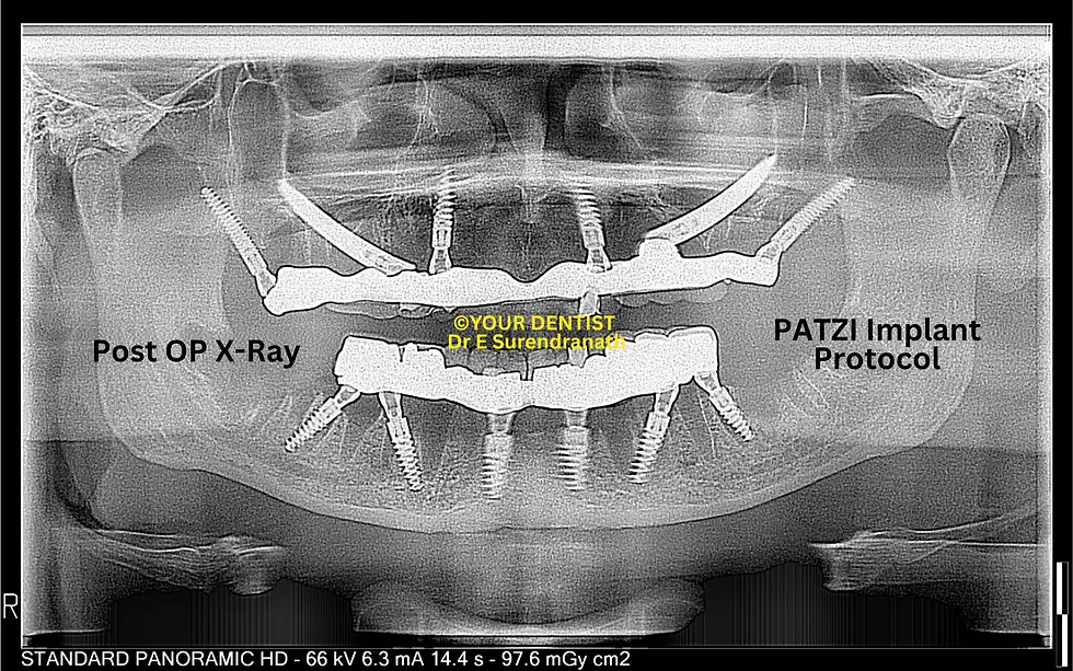 PATZI implant protocol X-ray with full mouth implant placement vijayawada