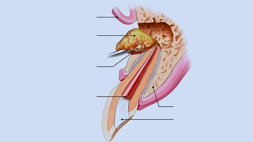 Labeled medical illustration of apicoectomy root-end surgery showing removal of infected tissue and root tip.