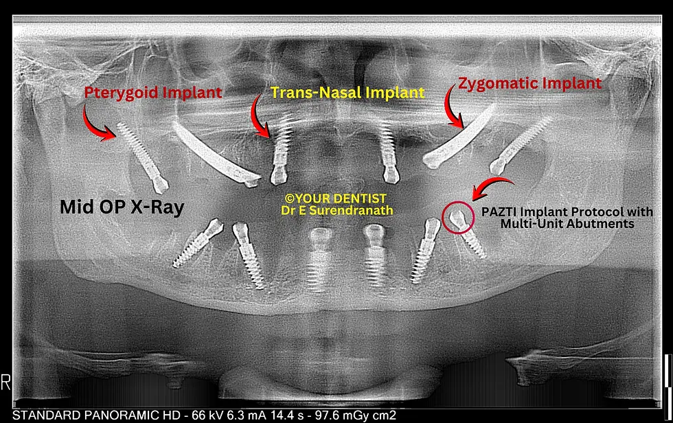Mid-operative panoramic X-ray showing zygomatic, pterygoid, and trans-nasal implants with multi-unit abutments in PATZI dental implant protocol at YOUR DENTIST Vijayawada
