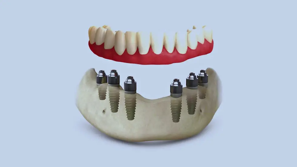 3D model showing six dental implants anchoring a full lower arch prosthesis.
