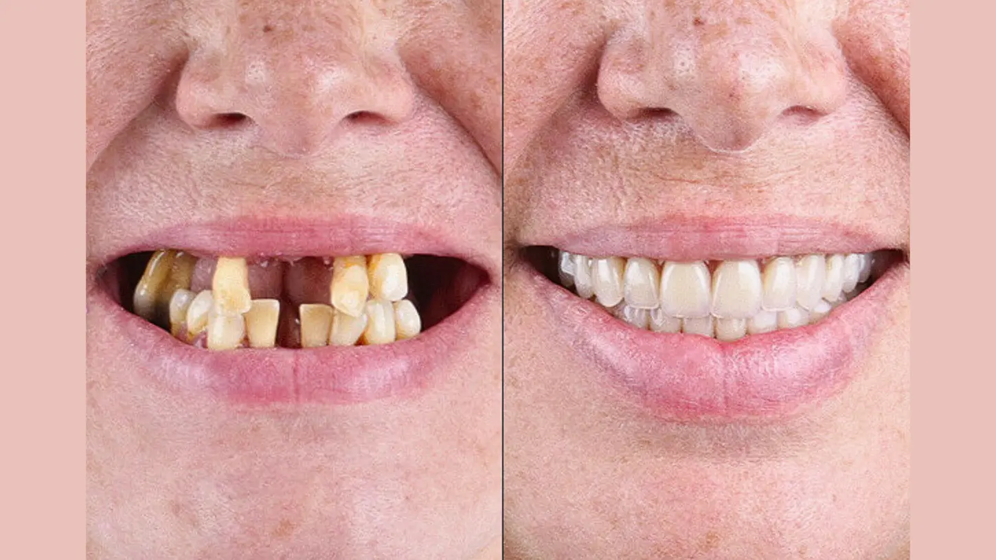 Before and after transformation of teeth showing full mouth rehabilitation with dental restorations and improved smile