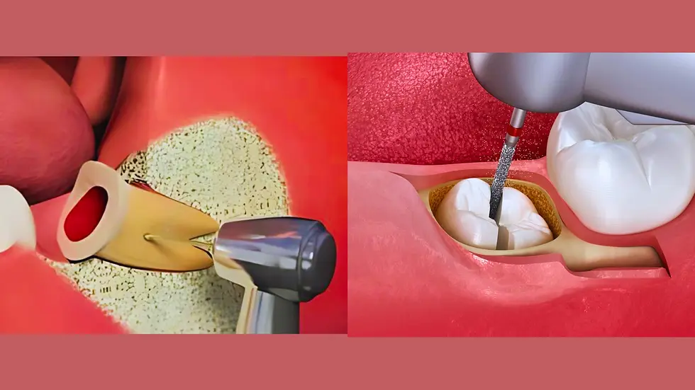 Step-by-step illustration of surgical wisdom tooth extraction using tooth sectioning and dental drill techniques.