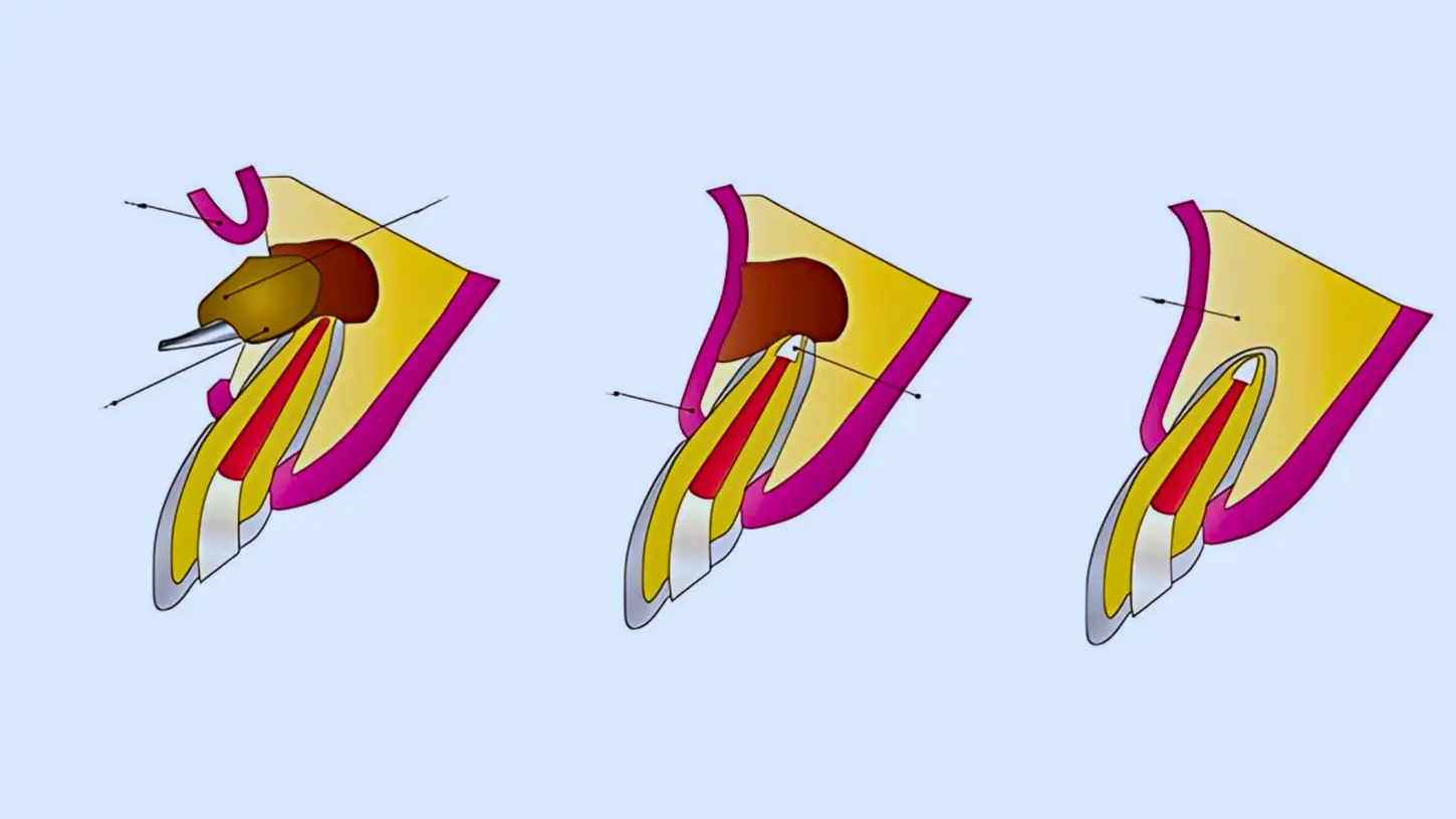 Stepwise diagram showing apicoectomy root-end surgery with removal of root tip and retrograde filling.