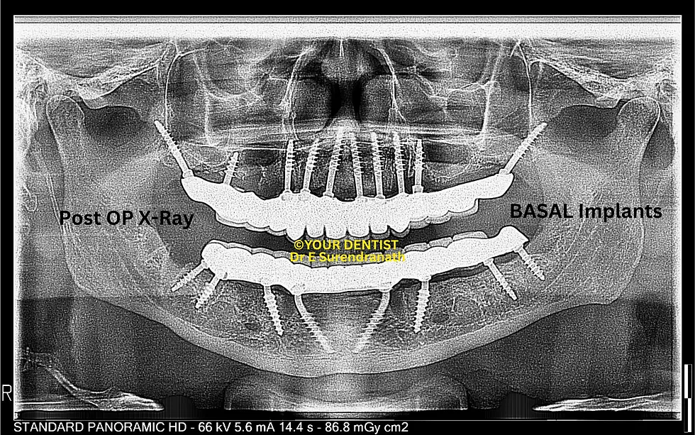 Basal dental implants post operative X-ray full mouth rehabilitation Vijayawada