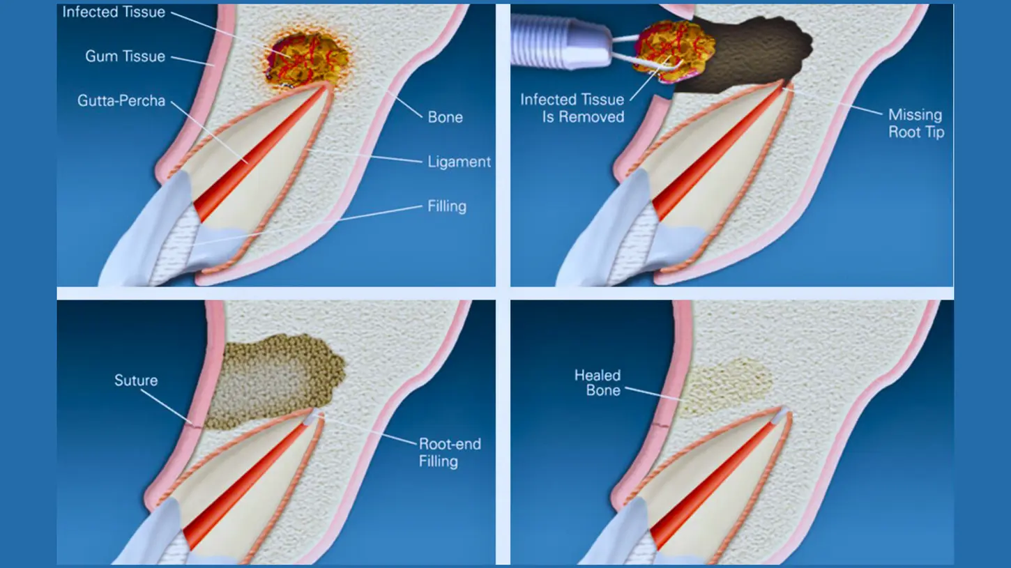 Step-by-step illustration of apicoectomy root-end surgery, showing removal of infected tissue and bone healing.