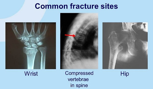 all-about-osteoporosis-what-is-osteoporo