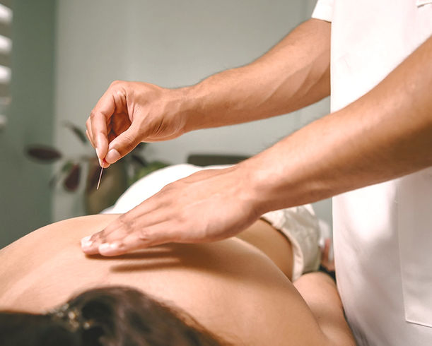 acupuncture needles being inserted into patients back