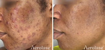 Laser Facial Before and After Acne