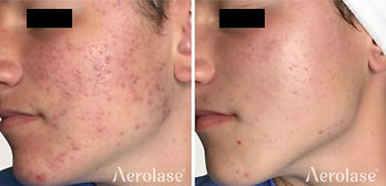 Laser Facial Before and After Acne