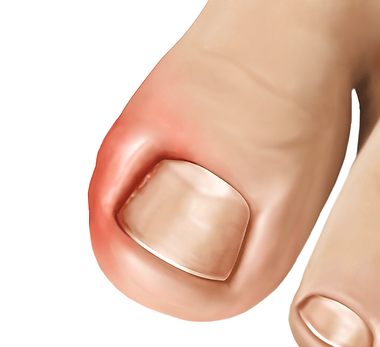 ingrown-toenail.png