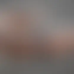 What to Know Before Getting Dental Implants or Dentures