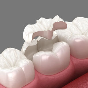 Crown vs. Filling: Which One is Best for You?