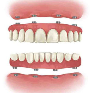 What to Know About Dental Bridges