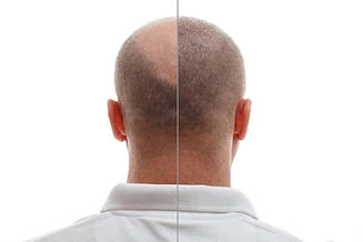 head-balding-man-before-after-hair-transplant-surgery-man-losing-his-hair-has-become.jpg