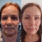 facial rejuvenation