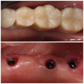 All Ceramic bridge replacing multiple missing teeth using implants