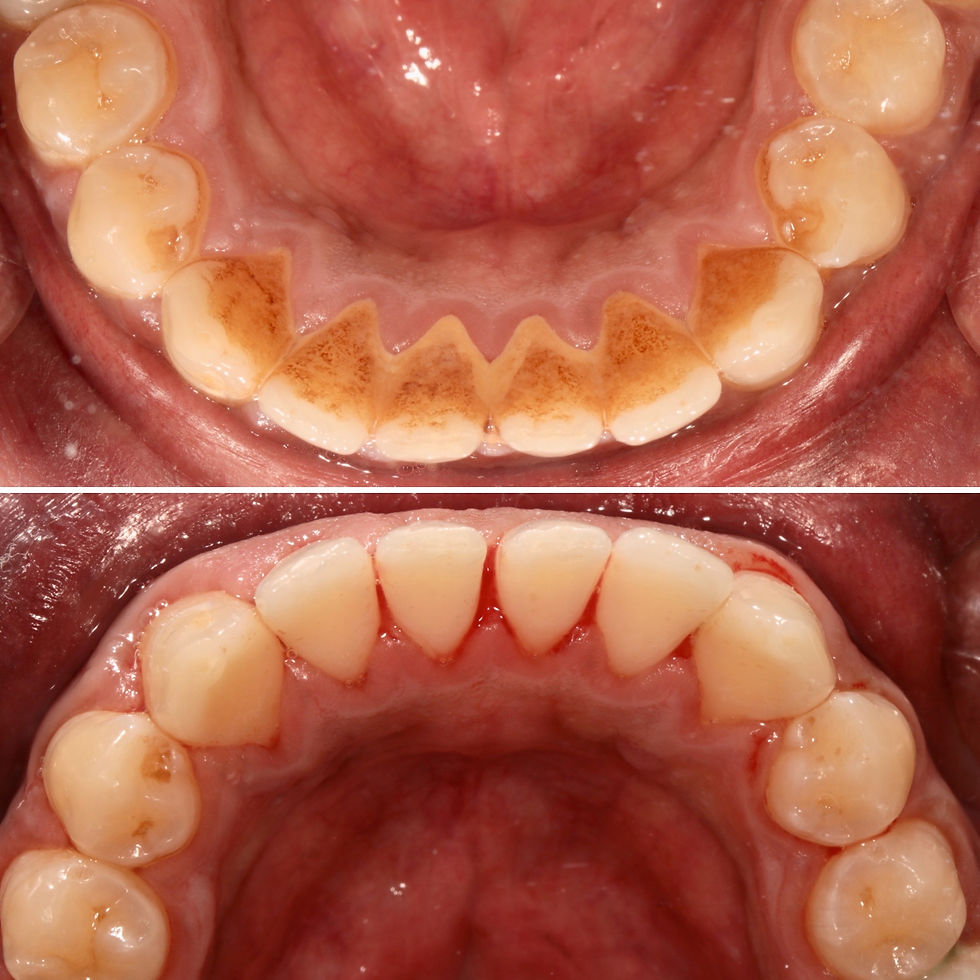 Guided Biofilm therapy improves overall oral health.