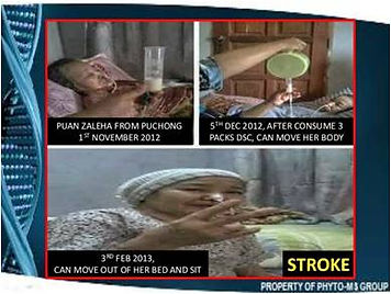 Double stem cells testimonial from a stroke patient