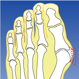 Bunion.gif