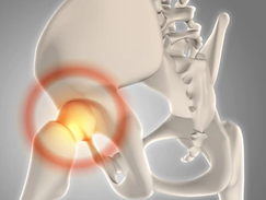 Procedimento de prateleira para a doença de Legg-Calvé-Perthes, é uma alternativa?