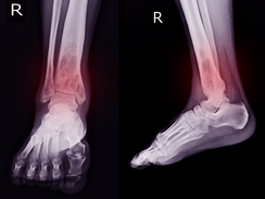 O que são Osteocondroses Juvenis e quais são as mais conhecidas