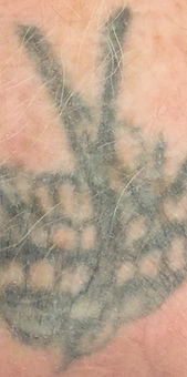 Tattoo before Treartment