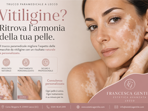 Vitiligine a Lecco: come migliorare l’aspetto della pelle con il trucco paramedicale