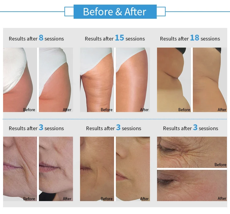 risultati rapidi dimagrimento sculpt lipolaser liposuzione indolore 