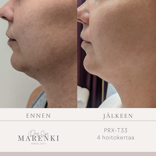 prx-t33 kasvohoito helsinki