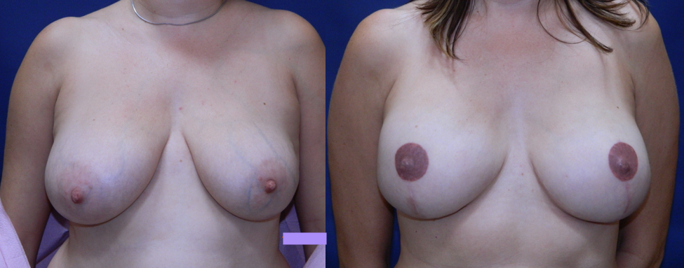 Flap Dermal con Implantes Bilaterales