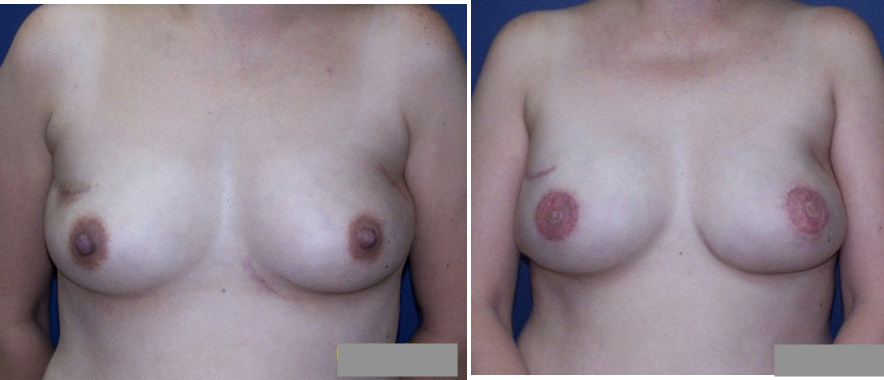 Latissimus Dorsi Flap Bilateral